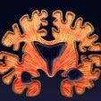 ps48.jpg Alzheimer Disease Brain coronal slice