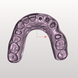 Capture-d’écran-2024-11-18-141524.png B.1 Inlay-core and maxillary bridge