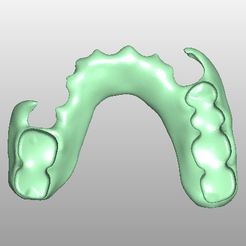 Clipboard-2024-02-25-15-03-57.jpg FLEXIBLE PARTIAL DENTURE (upper base + artificial teeth)