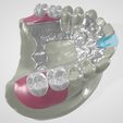 Kennedy-Class-I-Mod-1-Maxillary-3.png Prosthodontics Kennedy Class I Mod 1 Maxillary Removable partial denture (RPD)