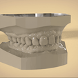 Screenshot_19.png STL file Digital Orthodontic Study Models with Virtual Bases・3D printing idea to download