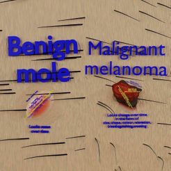 mole-nevus-cancer-malignant-melanoma-differences-3d-model-204eedbbe5.jpg Mole nevus cancer Malignant melanoma differences 3D model
