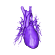 OBJ1.obj 3D Model of Human Heart with Atrio-Ventricular Septal Defect (AVSD) - generated from real patient