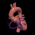 6.jpg 3D Model of Heart with Atrial Septal Defect
