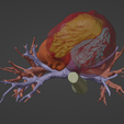 6.png 3D Model of Human Heart with Atrio-Ventricular Septal Defect (AVSD) - generated from real patient