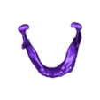 Mand 7.stl Jaw with Bone Damage due to Tumor