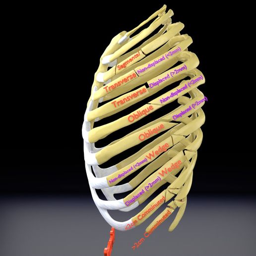STL file Rib fracture and its types 🦴 ・Design to download and 3D print ...