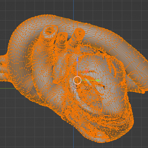 25.png 3D Model of Partial Anomalous Pulmonary Venous Connection