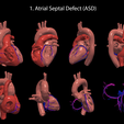 1.ASD.png Congenital Heart Disease - 7pack