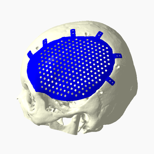 Capture2.png CRANIAL IMPLANT WITH DEFECT