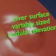 liver-cancer-hcc-vs-metastatic-3d-model-66c1d4a81b.jpg Liver cancer HCC vs Metastatic 3D model