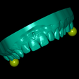 UpperJaw-articulator.png Dental Model With 10 Veneers and Articulator