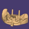 Clipboard-2024-12-21-00-08-07.jpg DIGITAL FLEXIBLE PARTIAL DENTURES upper + lower (3D models !!!) - 12 stl files for download