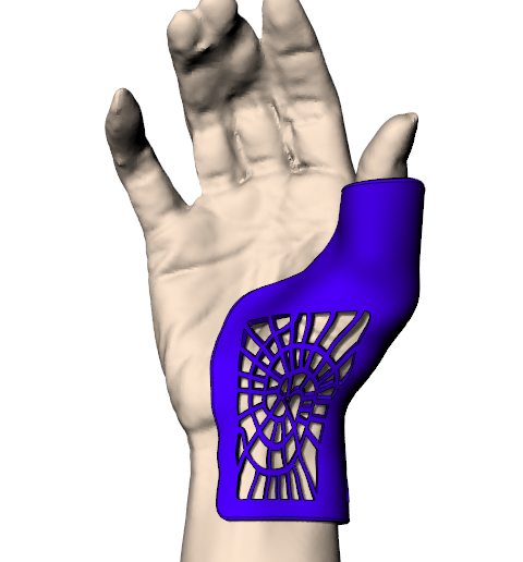 Mano _ Ferula_Tenosinovitis de De Quervain