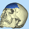 6.png CRANIAL PLATE MADE ACCORDING TO DEFECT