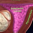 10.jpeg Útero normal frente a tipos de fibromas 3d set