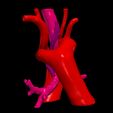3.jpg 3D Model of Double Aortic Arch