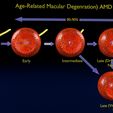 md1310.jpg Age-related macular degeneration AMD ARMD detailed labelled