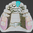 Kennedy-Class-I-Mod-1-Maxillary-5.png Prosthodontics Kennedy Class I Mod 1 Maxillary Removable partial denture (RPD)