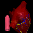 3.png 3D Model of Heart wirh Atrioventricular Septal Defect, 4 chamber view