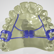 molar-distalizer,-teeth,-dental,-tooth,-palatal-expander,-appliance,-removable,-hilgers,-orthodontic.png High resolution Rapid Palatal Expander (Banded type) Dental appliance on Upper teeth