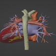 4.png 3D Model of Human Heart with Hypertrophic Cardiomyopathy - generated from real patient