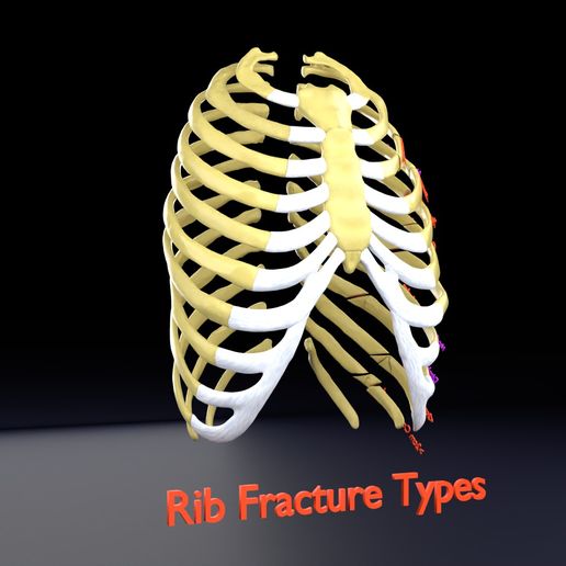 STL file Rib fracture and its types 🦴 ・Design to download and 3D print ...