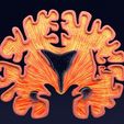 ps47.jpg Alzheimer Disease Brain coronal slice