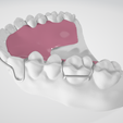 Standard-Hawley-dental-appliance-3.png High resolution Standard Hawley Dental Appliance