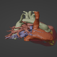 3.png 3D Model of Human Heart with Double Outlet Right Ventricle (DORV) - generated from real patient