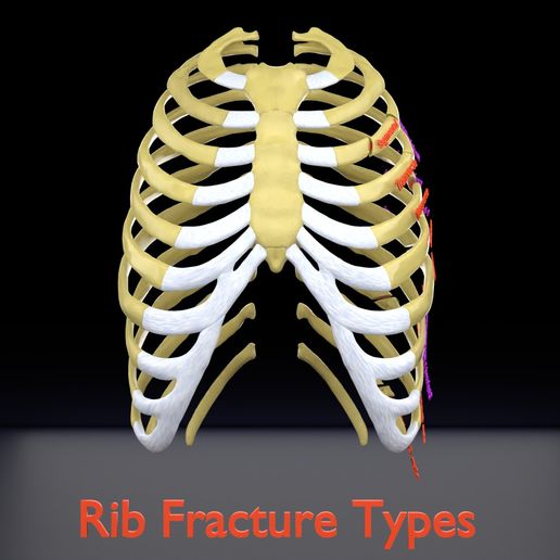 STL file Rib fracture and its types 🦴 ・Design to download and 3D print ...