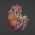 12.png 3D Model of Human Heart with Ventricular Septal Defect (VSD)