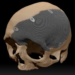 Skull.jpg Placa craneal fabricada según datos antropométricos (un caso interesante)