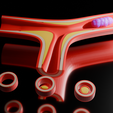 Athero-Artery-printable.png Atherosclerosis educational model