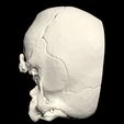 15.jpg 3D Model of Middle Cerebral Artery (MCA) Aneurysm