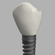 1.png Educational Dental Implant Macromodel