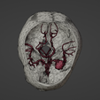 t2.png 3D Model of Middle Cerebral Artery (MCA) Aneurysm