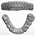 All-on-X-Lower-Bridge.png Mandibular All on X Implant Retained Bridge