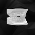 open-bite1.jpg Descargar archivo STL modelo dental - mordida abierta • Objeto para impresión 3D, Fil_3D