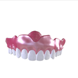 21.png Digital Full Dentures with Combined Glue-in Teeth Arch