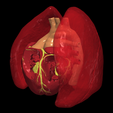 5.png 3D Model of Transposition of the Great Arteries Open Duct