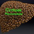 ps13.jpg 3D Alchoholic liver disease cirrhosis hepatitis fatty model