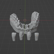 1.png Dental model with removable dies