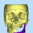 2.png MANDIBLE IMPLANT