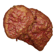 cirrhosis_002-2.png Anatomical model of the liver with cirrhosis