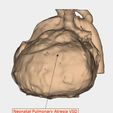 10.jpg congenital heart disease classification ( CHD )