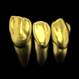 Gold.png Anatomical dental bridge