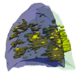 9.png 3D Model of Lungs Infected with Covid19