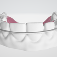 Standard-Hawley-dental-appliance-2.png High resolution Standard Hawley Dental Appliance