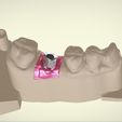 Snapshot_2017-2-10_20-59-11.jpg Digital Implant Model with Positioning Guide